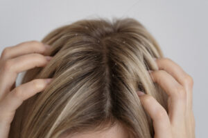treatment of dandruff